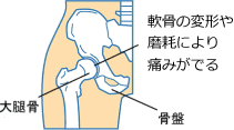 変形性股関節症の手